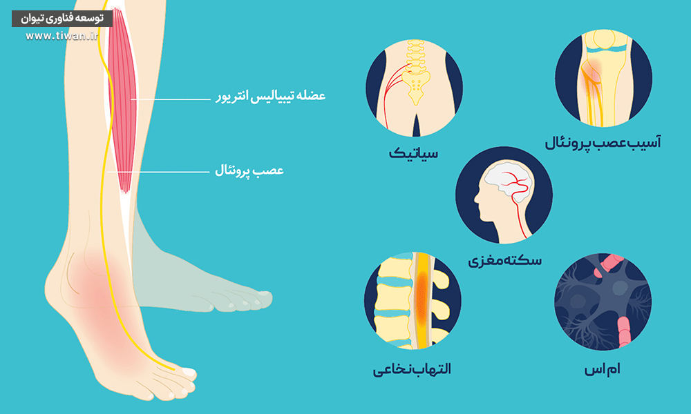 علل افتادگی پا