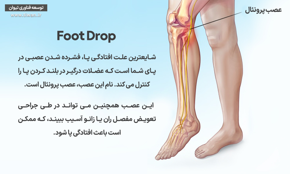 فوت دراپ - افتادگی پا
